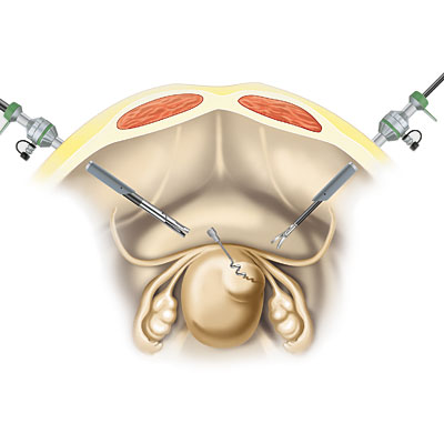 Endoscopic Myoma Screw with Detachable Myoma Drill-Product Picture Enlargement CW